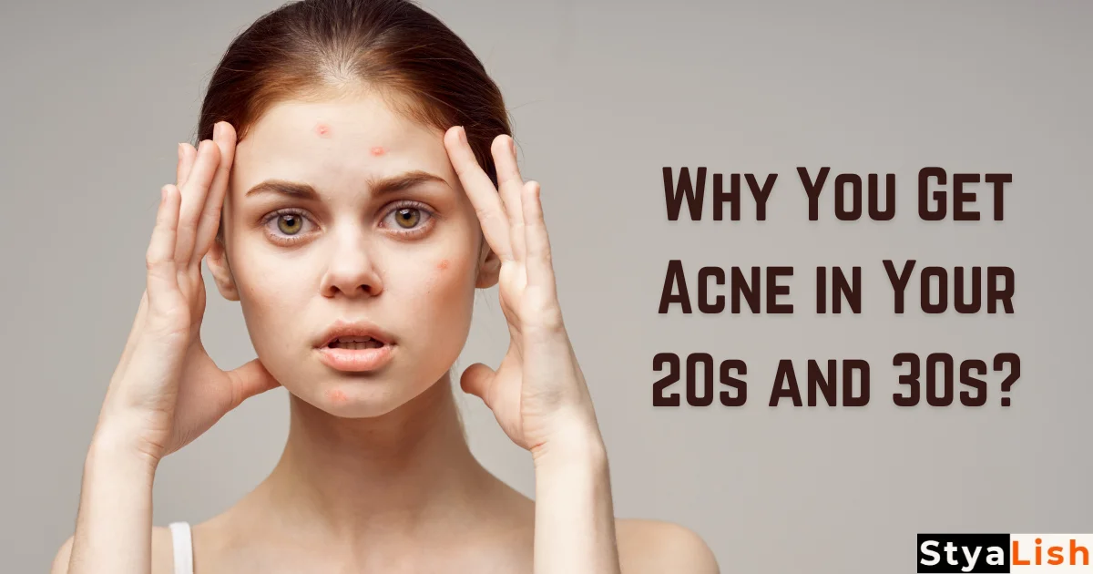 Why You Get Acne in Your 20s and 30s?